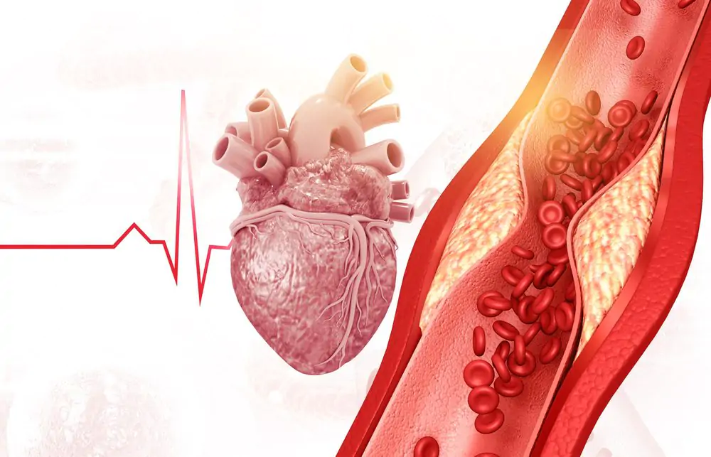 EECP Therapy for Heart Disease